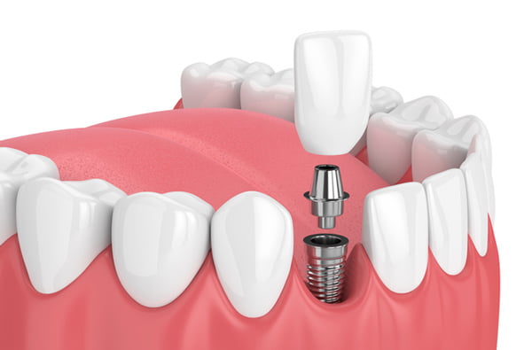 ایمپلنت دندانپزشکی دندان چیست