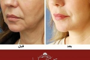 هر آنچه باید از هایفوتراپی بدانید