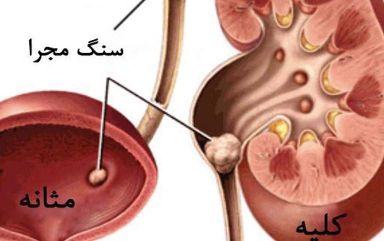 پیشگیری و درمان سنگ مثانه در منزل