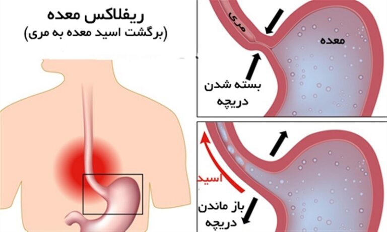 چه غذاهایی به رفلاکس معده کمک می کنند؟