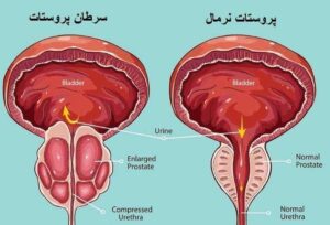 همه چیز درباره سرطان پروستات