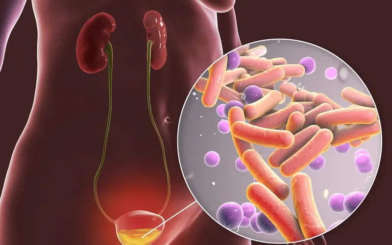 سریع‌ترین درمان خانگی عفونت ادراری | ۸ راهکار اورژانسی برای تسکین درد
