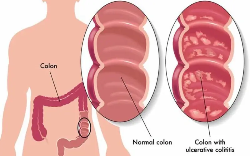زخم روده چیست؟ علائم، پیشگیری و جدیدترین روش‌های درمان