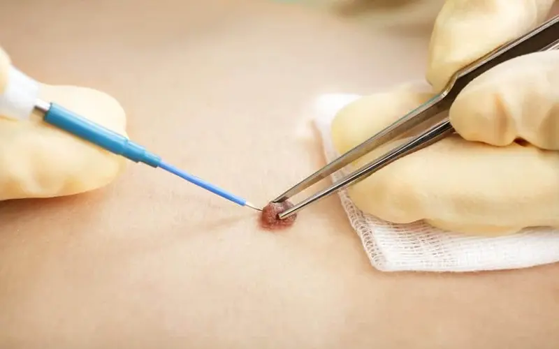 بهترین روش‌های از بین بردن خال گوشتی؛ از درمان‌های خانگی تا جراحی پزشکی